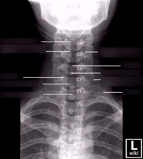 Ap Axial C Spine X Ray Anatomy Diagram Quizlet
