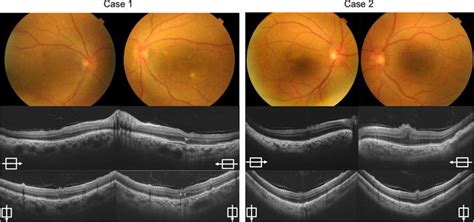 The Color Fundus Photographs And Swept Source Optical Coherence