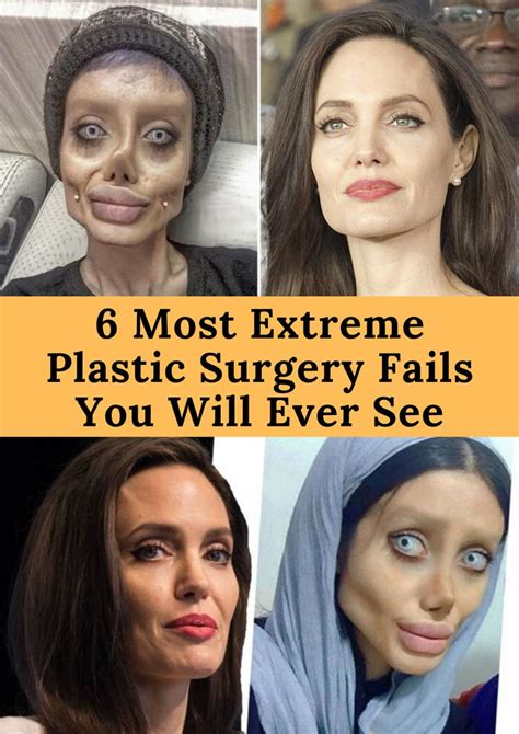 6 Most Extreme Plastic Surgery Fails You Will Ever See Extreme