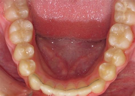 Braces Occlusal Photo Of Mandibular Dentition After Flickr
