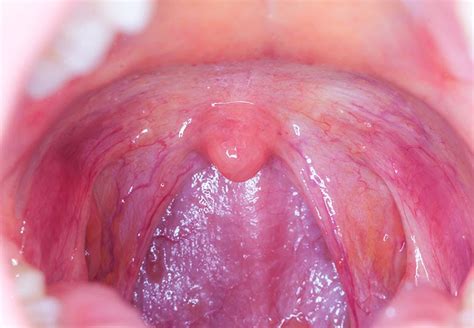 How To Recognize Symptoms Of Throat Cancer