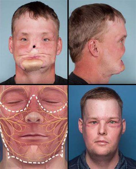 Incredible Well Performed Face Transplant Rmedizzy