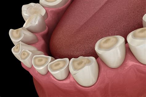 Teeth Grinding Bruxism Broad Smiles Pediatric Dentistry