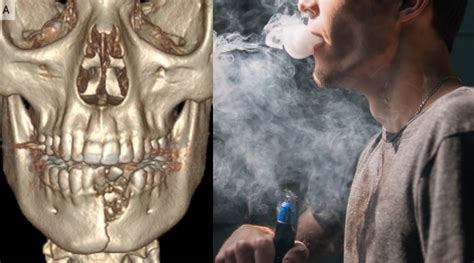 Teens Jaw Shatters After E Cigarette Explodes In His Mouth Rare