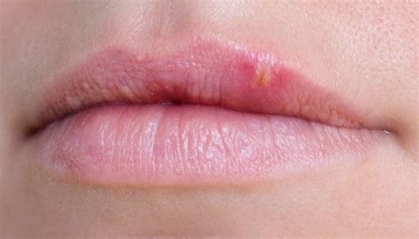 Spontané Faire Face Ruckus Tiny Spots On Lips Abandonné Coussin Résoudre