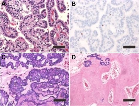 Histopathology Of Choroid Plexus Tumor On Hematoxylin And