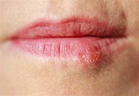 Cold Sore Vs Lip Pimple Whats The Difference Cleveland Clinic