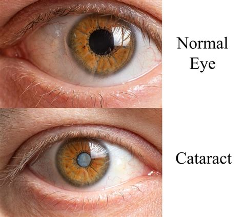 10 Common Questions About Cataracts Ke Eye Centers Of Texas