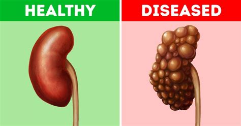 8 Common Habits That Can Damage Your Kidneys