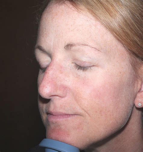 Before And After Pictures Of Actinic Keratosis In Charlotte Nc And