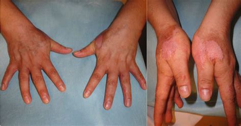 Topical Drug Induced Subacute Cutaneous Lupus Erythematosus Isolated To The Hands Lupus
