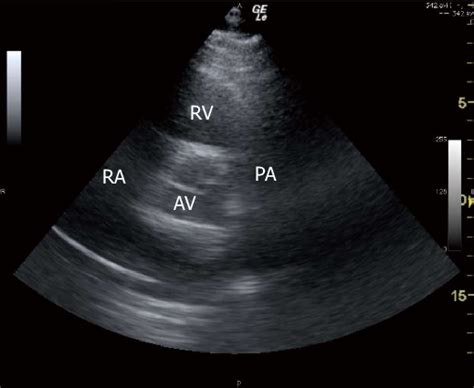 Parasternal Right Ventricular Inflow Outflow View Sonogram Ra Right