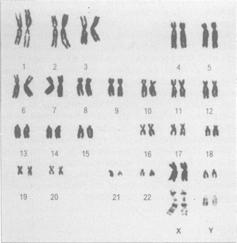 Chromosome Analysis Of The Patient Showing Non Mosaic 48 Xxyy