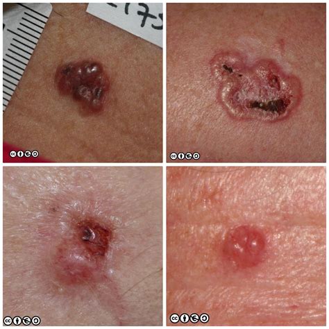 Basal Cell Carcinoma Late Stages