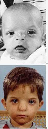 Craniofacial Clefts And Hypertelorbitism Plastic Surgery Key