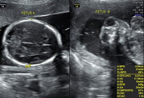 Mono Chorionic Di Amniotic Twin Pregnancy With Anencephaly Of One Fetus Looking Through A
