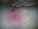 Heating Pad Burns Pictures