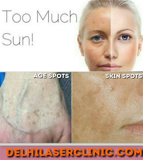 Sun Spots Age Spots And Other Spots Are Various Names For