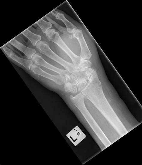 Slac Wrist And Distal Radius Fracture Image