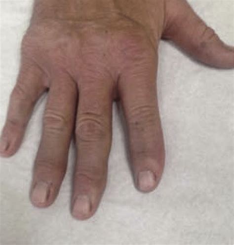 E Photograph Of The Dorsum Of The Hand Taken April Showing Near Download Scientific