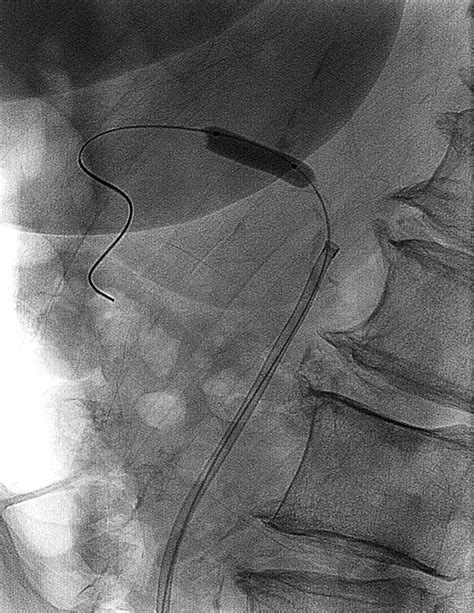 Balloon Angioplasty X Ray Photograph By Du Cane Medical Imaging Ltd