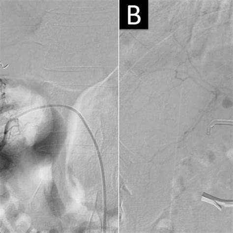 A The First Angiogram Revealed A 3 Cm Pseudoaneurysm Black Arrow