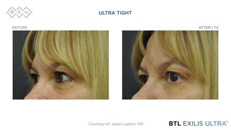 Btl Exilis Ultra Before And After Video Youtube