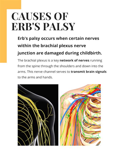 Erbs Palsy Birth Injury Help Center