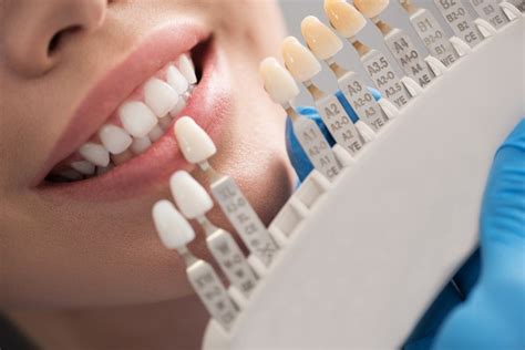 How Do Dentists Color Match Dental Crowns Dr Robert Graffeo Dds