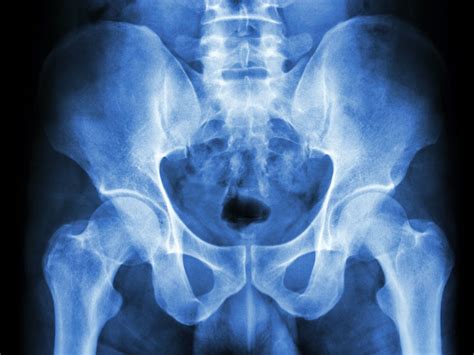 X Ray Of The Pelvis Purpose Procedure And Risks