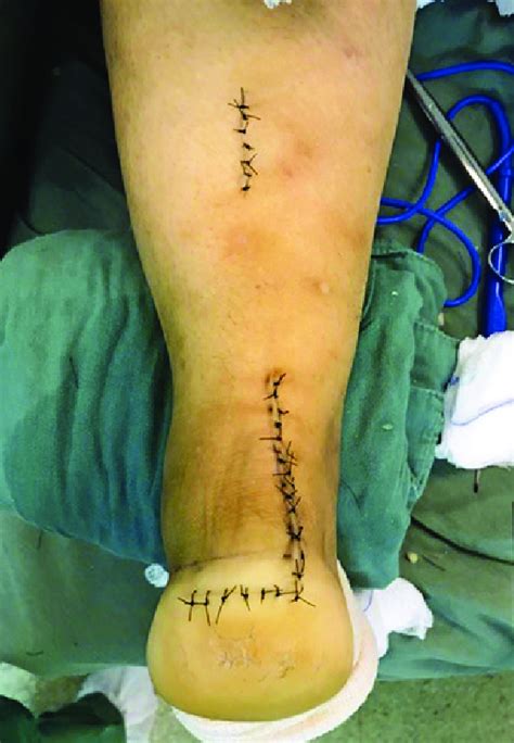 Medial Incision In The Calcaneal Tendon With Inverted J Extension