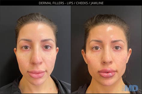 Dermal Fillers Boston Skin Md Laser And Cosmetic Group
