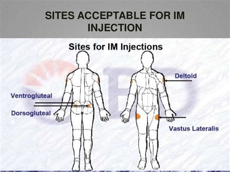 8 best intramuscular injection sites images intramuscular injection sites nursing notes im