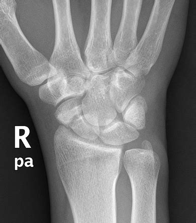 Scaphoid Fracture Summary Radiology Reference Article Radiopaedia Org