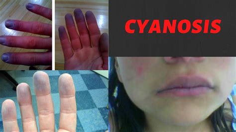 Cyanosis Causes Symptoms Types Treatment I What Is Cyanosis Peripheral And Central
