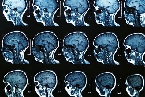 Ai Identifies Three Subtypes Of Multiple Sclerosis In Mri Brain Scans
