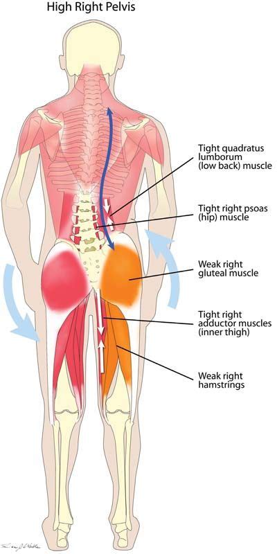 This muscle assists with the external rotation of the hip. High Hip A misaligned pelvis (one side higher than the ...