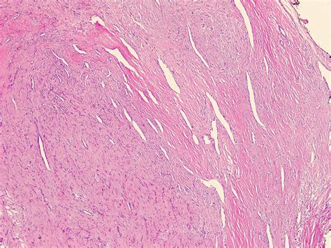 Pathology Outlines Fibroma Of Tendon Sheath