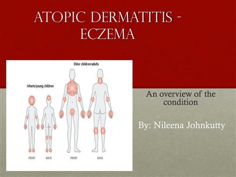 Ppt Atopic Dermatitis Eczema Powerpoint Presentation Free Download