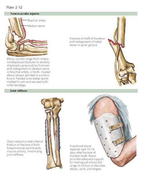 Complications Of Fracture A Major Objective In The Management Of