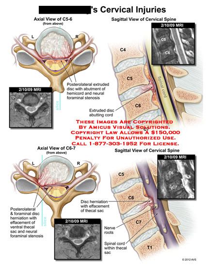 Amicus Illustration Of Amicusinjurycervicalspineinjuriesextruded