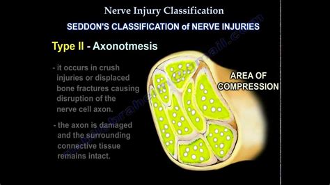 Nerve Injury Types Nerve Recovery Everything You Need To Know Dr