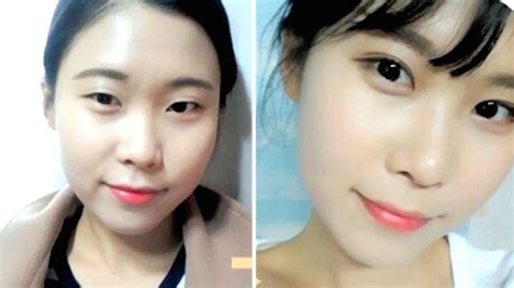 Korean Double Eyelid Surgery Before After Youtube