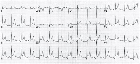 Dr Smiths Ecg Blog Why Is There St Depression In Avl In