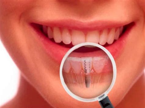 Cuáles son las fases de colocación de un implante Clínica Dental Satorres