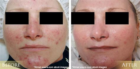 Ipl Photofacial Before And After Pictures Morehead City New Bern Nc