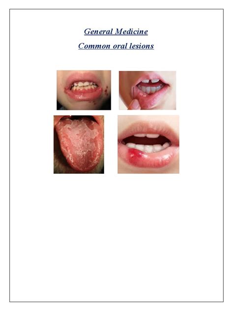 Common Oral Lesions Pdf Mouth Cutaneous Conditions