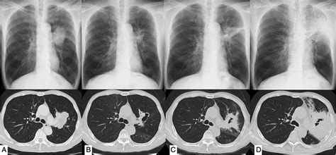 Subacute Invasive Pulmonary Aspergillosis After Chemoradiotherapy For
