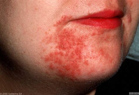 Rashes In The Mouth Pictures Photos