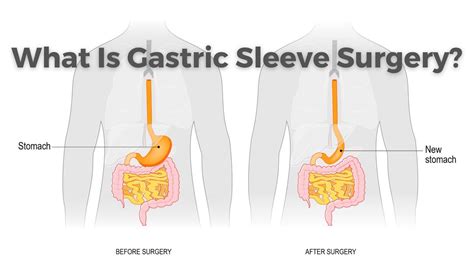 What Is Gastric Sleeve Surgery Healthylifebariatrics